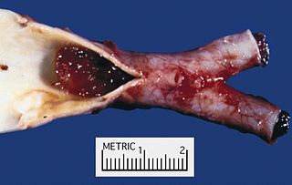 <span class="mw-page-title-main">Arterial embolism</span> Interruption of blood flow to an organ