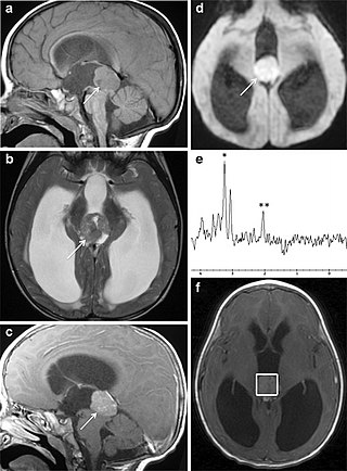 <span class="mw-page-title-main">Pineoblastoma</span> Medical condition