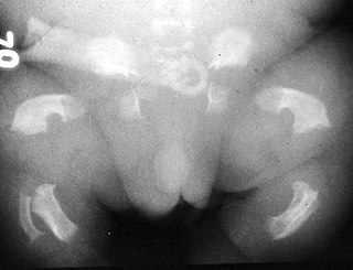 <span class="mw-page-title-main">Thanatophoric dysplasia</span> Severe form of genetic dwarfism that is usually lethal