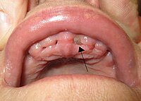 Alveolar osteitis of a socket after tooth extraction. Note lack of blood clot in socket and exposed alveolar bone. DrySocket.JPG