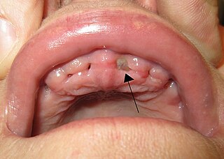 <span class="mw-page-title-main">Alveolar osteitis</span> Medical condition