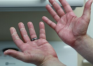 <span class="mw-page-title-main">Chemotherapy-induced acral erythema</span> Medical condition