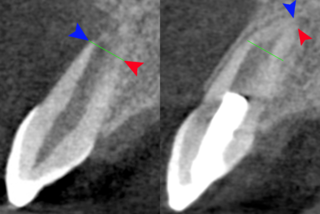 <span class="mw-page-title-main">Regenerative endodontics</span> Dental specialty