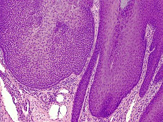 <span class="mw-page-title-main">Trichilemmoma</span> Medical condition