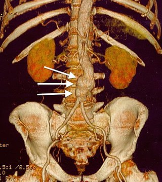 <span class="mw-page-title-main">Abdominal aortic aneurysm</span> Localized enlargement of the abdominal aorta