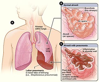 <span class="mw-page-title-main">Lobar pneumonia</span> Medical condition