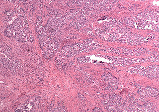 <span class="mw-page-title-main">Mixed Müllerian tumor</span> Medical condition