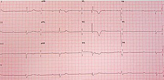 Third-degree atrioventricular block Medical condition