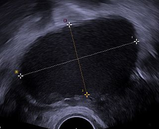 <span class="mw-page-title-main">Endometrioma</span> Medical condition