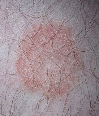 <span class="mw-page-title-main">Dermatophytosis</span> Fungal infection of the skin