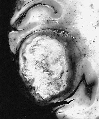 <span class="mw-page-title-main">Giant-cell glioblastoma</span> Tumor of the central nervous system