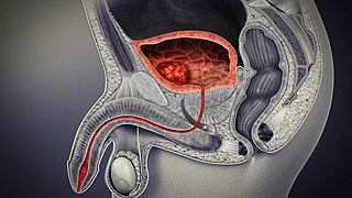 <span class="mw-page-title-main">Underactive bladder</span> Bladder syndrome