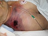 Gas gangrene of the shoulder.