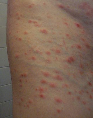 <span class="mw-page-title-main">Pityriasis lichenoides</span> Medical condition