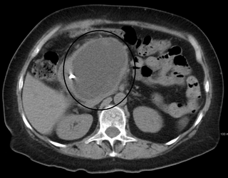 <span class="mw-page-title-main">Pancreatic pseudocyst</span> Medical condition