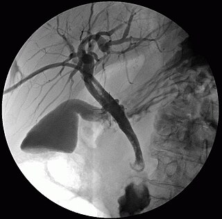 <span class="mw-page-title-main">Percutaneous transhepatic cholangiography</span> Medical imaging of the biliary tract