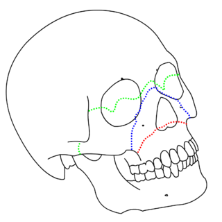 <span class="mw-page-title-main">Le Fort fracture of skull</span> Medical condition