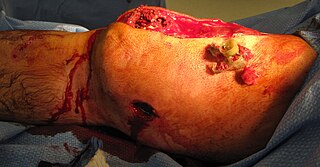 Penetrating trauma Type of injury