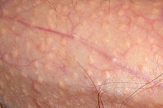 <span class="mw-page-title-main">Fordyce spots</span> Sebaceous glands that are present in most individuals