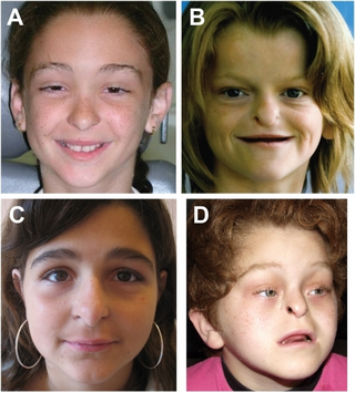 <span class="mw-page-title-main">Johanson–Blizzard syndrome</span> Medical condition