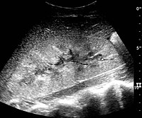 Renal ultrasonograph in renal failure after surgery with increased cortical echogenicity and kidney size. Biopsy showed acute tubular necrosis.[18]