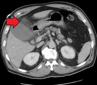 <span class="mw-page-title-main">Cholecystitis</span> Inflammation of the gallbladder