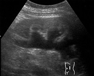 <span class="mw-page-title-main">Hydronephrosis</span> Dilation of the renal pelvis due to obstruction of urine flow