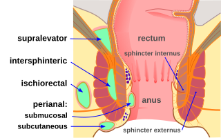 Anorectal abscess Medical condition