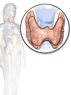 Thyroid disease type of endocrine disease