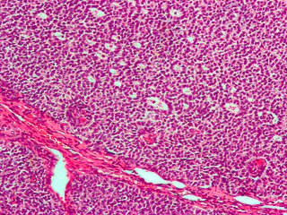 <span class="mw-page-title-main">Sex cord–gonadal stromal tumour</span> Medical condition