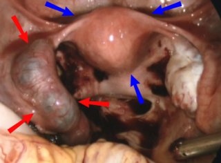 <span class="mw-page-title-main">Ectopic pregnancy</span> Female reproductive system health issue