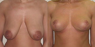 <span class="mw-page-title-main">Mammaplasty</span> Surgically modifying the appearance of the breast