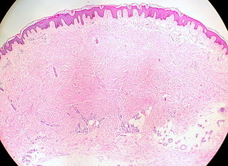 <span class="mw-page-title-main">Cutaneous leiomyoma</span> Medical condition