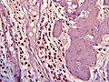 Histopathology of eosinophilic cholecystitis