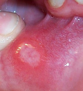 Aphthous stomatitis Common condition involving ulceration of the oral mucosa.