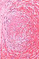 Μικρογραφία που δείχνει έναν θρόμβο (κέντρο εικόνας) μέσα σε ένα αιμοφόρο αγγείο του πλακούντα. Σημάδι H&E.