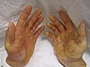 Epidermolysis bullosa simplex HandsEBS.JPG