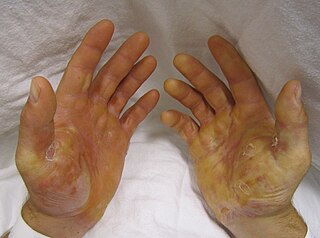 <span class="mw-page-title-main">Epidermolysis bullosa simplex</span> Medical condition