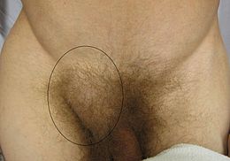 Description de l'image Hernia.JPG.