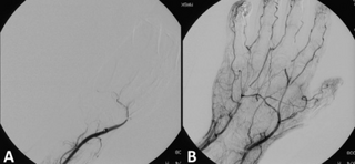 <span class="mw-page-title-main">Thrombolysis</span> Breakdown (lysis) of blood clots formed in blood vessels, using medication