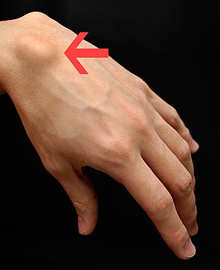 <span class="mw-page-title-main">Ganglion cyst</span> Medical condition