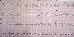 تخطيط القلب في شخص لديه مستوى بوتاسيوم يبلغ 1.1 مكافئ / لتر يوضح التغيرات الكلاسيكية لاكتئاب شريحة ST وموجات T المقلوبة وموجات U الكبيرة وفاصل العلاقات العامة المطول قليلا.