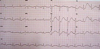 <span class="mw-page-title-main">Hypokalemia</span> Medical condition with insufficient potassium