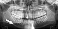 Radiografia panoramica di una semplice frattura della mandibola del corpo mandibolare destro, minimamente spostata. Si noti che i denti a sinistra della frattura non si toccano