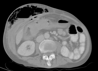 <span class="mw-page-title-main">Fistula</span> Abnormal connection between two epithelialized surfaces, often organs