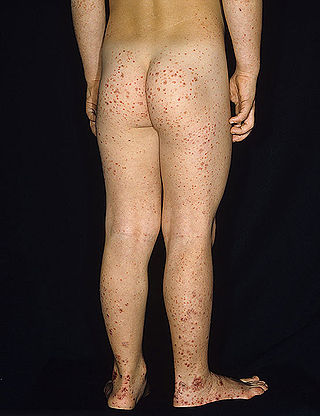 <span class="mw-page-title-main">Henoch–Schönlein purpura</span> Vascular inflammatory disease