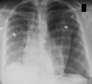 <span class="mw-page-title-main">Mediastinal shift</span> Medical condition