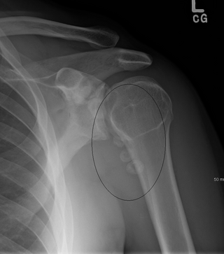 <span class="mw-page-title-main">Synovial osteochondromatosis</span> Medical condition