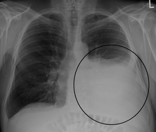 A large left-sided pleural effusion as seen on an upright chest X-ray Effusionhalf.PNG