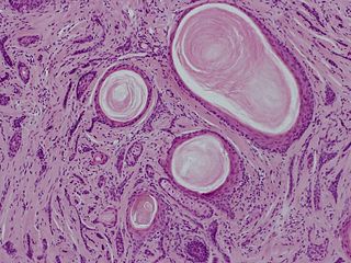 <span class="mw-page-title-main">Desmoplastic trichoepithelioma</span> Medical condition